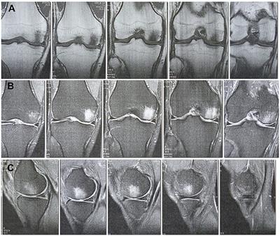 The Stromal Vascular Fraction From Fat Tissue in the Treatment of Osteochondral Knee Defect: Case Report